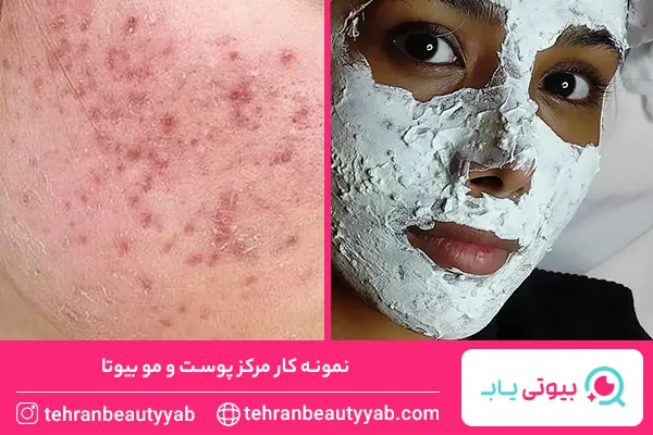 مرکز پاکسازی پوست در شرق تهران