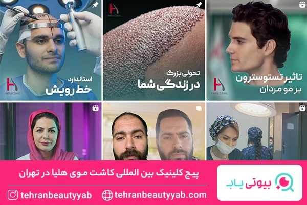 بهترین کلینیک کاشت مو در تهران