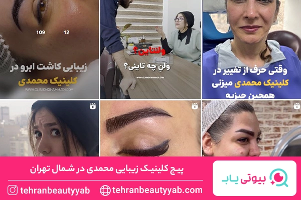 کاشت ابرو در شمال تهران