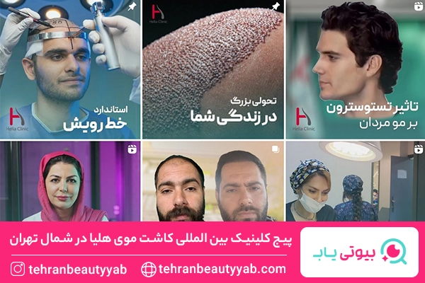 کاشت مو در شمال تهران