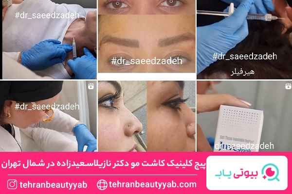 کاشت مو در شمال تهران