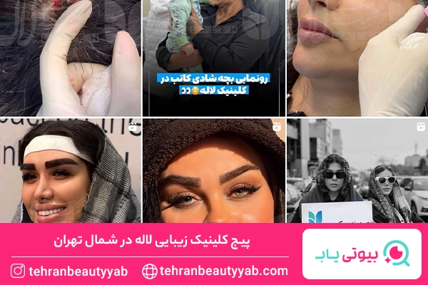 کاشت مو در شمال تهران