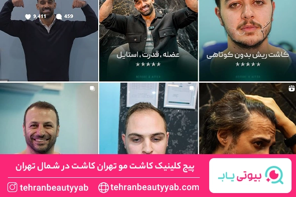 کاشت مو در شمال تهران