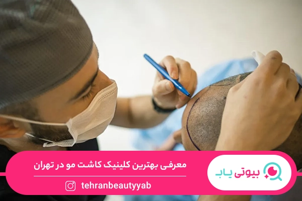 بهترین کلینیک کاشت مو در تهران