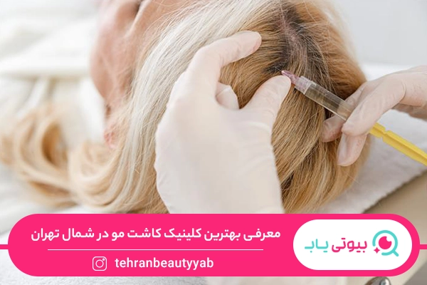 کاشت مو در شمال تهران