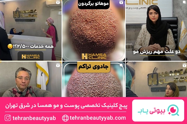 کاشت مو شرق تهران