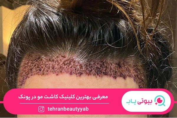 کلینیک کاشت مو در پونک