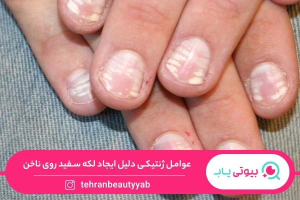 دلیل لکه های سفید روی ناخن