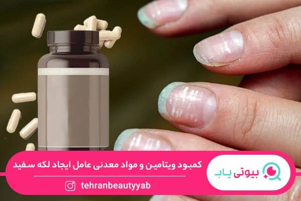 دلیل لکه های سفید روی ناخن