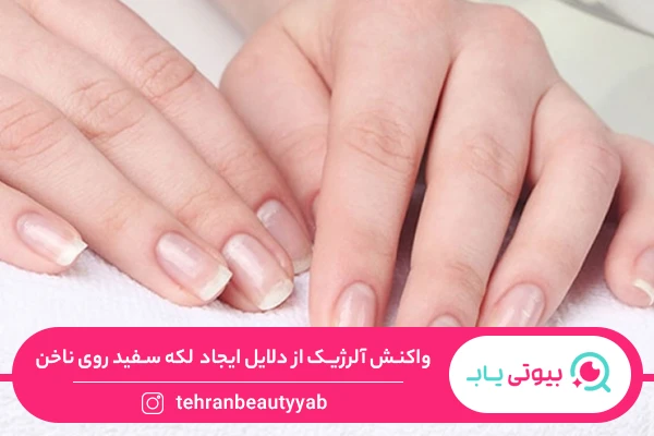دلیل لکه های سفید روی ناخن