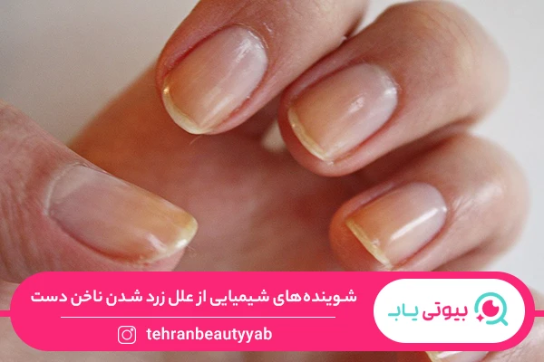 علت زرد شدن ناخن دست