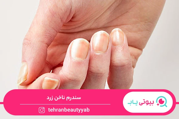 علت زرد شدن ناخن دست
