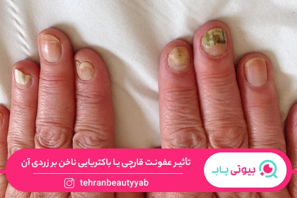 علت زرد شدن ناخن دست