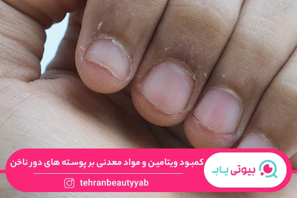 علت پوسته شدن دور ناخن