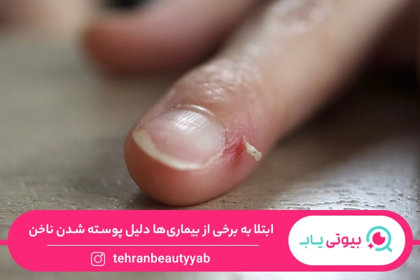 علت پوسته شدن دور ناخن