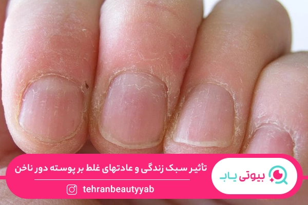 علت پوسته شدن دور ناخن