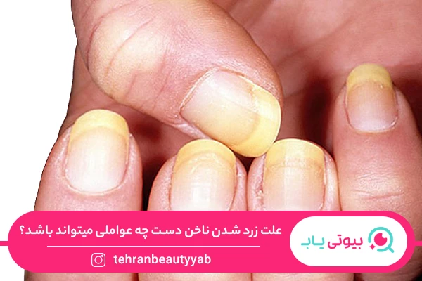 علت زرد شدن ناخن دست