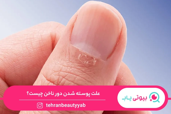 علت پوسته شدن دور ناخن