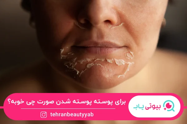 برای پوسته پوسته شدن صورت چی خوبه؟
