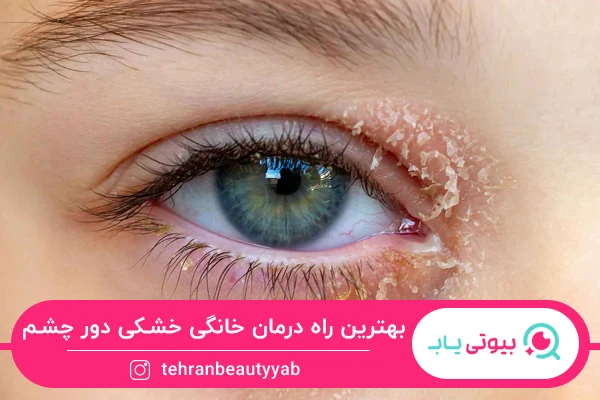 راه درمان خانگی خشکی دور چشم