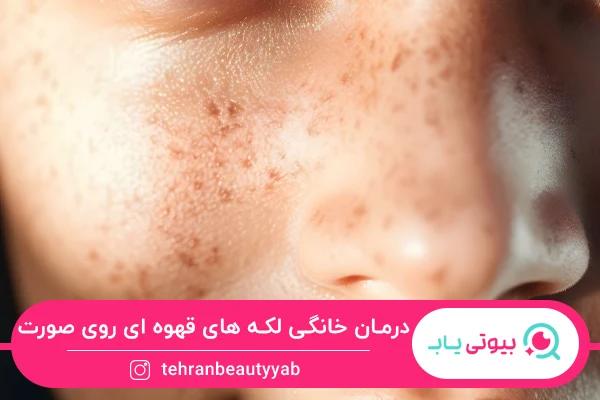 درمان خانگی لکه های قهوه ای روی صورت
