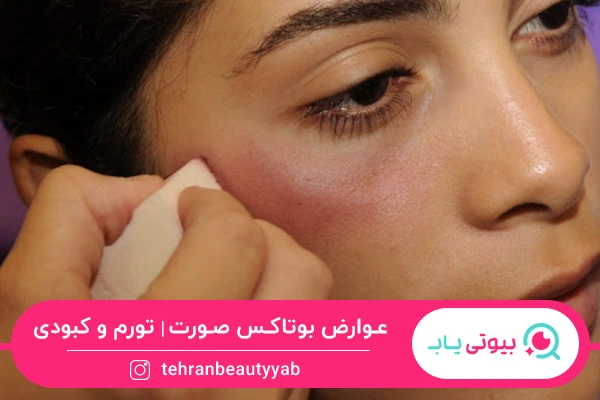 عوارض بوتاکس صورت