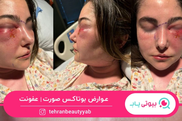 عوارض بوتاکس صورت