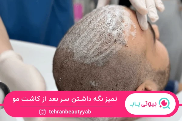 مراقبت بعد از کاشت مو