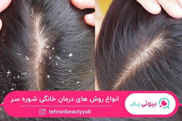 انواع روش های درمان خانگی شوره سر