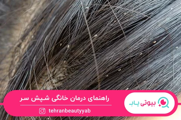 روش های درمان خانگی شپش سر
