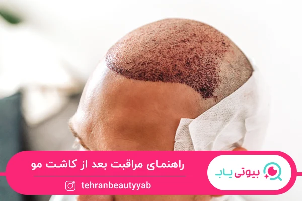 مراقبت بعد از کاشت مو