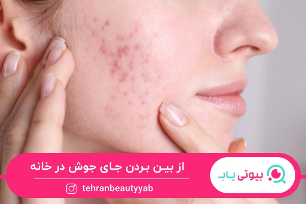 روش های از بین بردن جای جوش در خانه