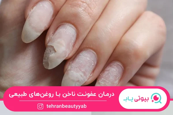 درمان خانگی عفونت ناخن با روغن های طبیعی