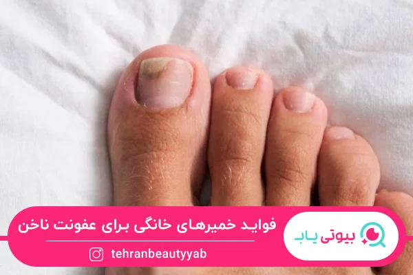 درمان خانگی عفونت ناخن با خمیرهای خانگی