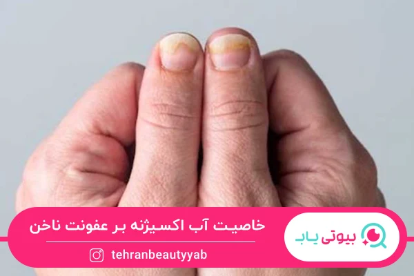 درمان خانگی عفونت ناخن با آب اکسیژنه