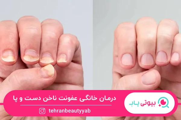 درمان خانگی عفونت ناخن