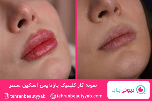 بهترین تزریق ژل لب در تهران