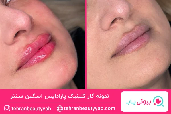 مرکز تزریق ژل در غرب تهران