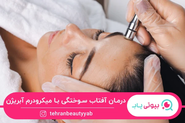 استفاده از میکرودرم آبریژن برای درمان آفتاب سوختگی پوست