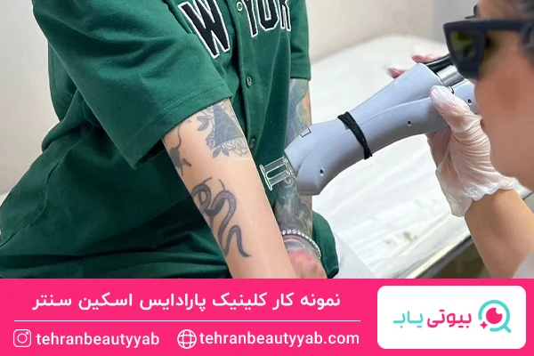 لیزر موهای زائد در کلینیک پارادایس