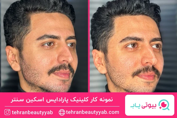 تزریق بوتاکس در کلینیک پارادایس اسکین سنتر