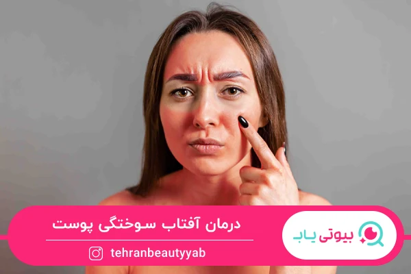 درمان آفتاب سوختگی پوست