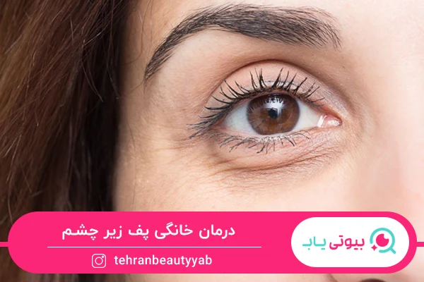 درمان خانگی پف زیر چشم